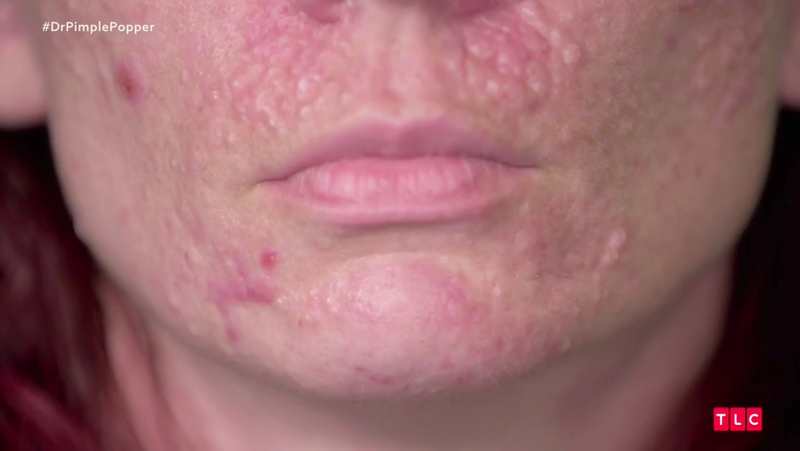 Illustration for article titled On Dr. Pimple Popper, the Bumps Run in the Family